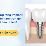 Giá trồng răng Implant nguyên hàm trọn gói hết bao nhiêu?